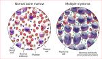 04252023-multiple-myeloma-thanh-mai