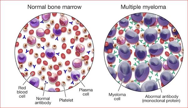 04252023 multiple myeloma_Thanh Mai