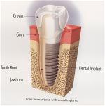 implant-root