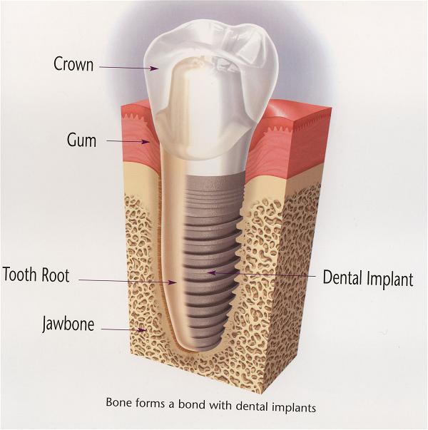 implant root